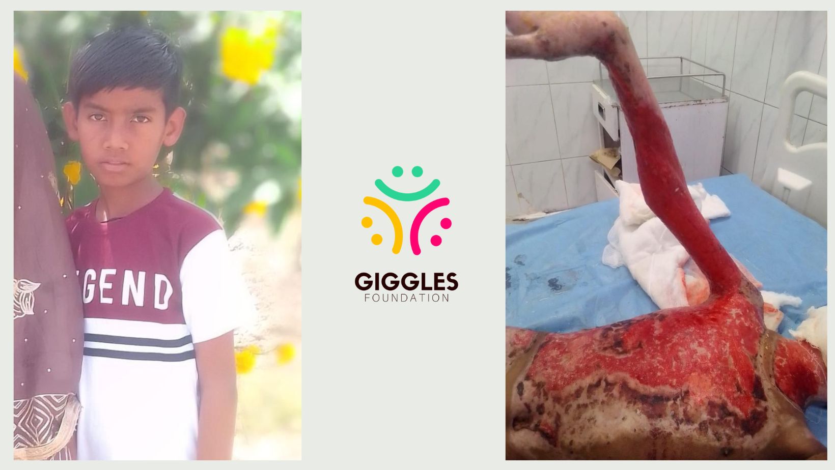 Help 10-Year-Old Vishal Heal from Severe Burns